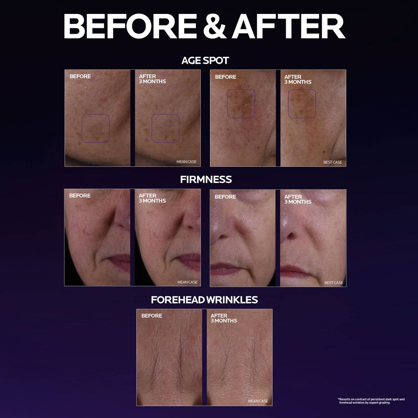 mela-b3-double-dose-discoloration-treatment-with-melasyltm-g1 MelaB3_DD_BTF_BeforeAfter_1500x1500_5.jpg