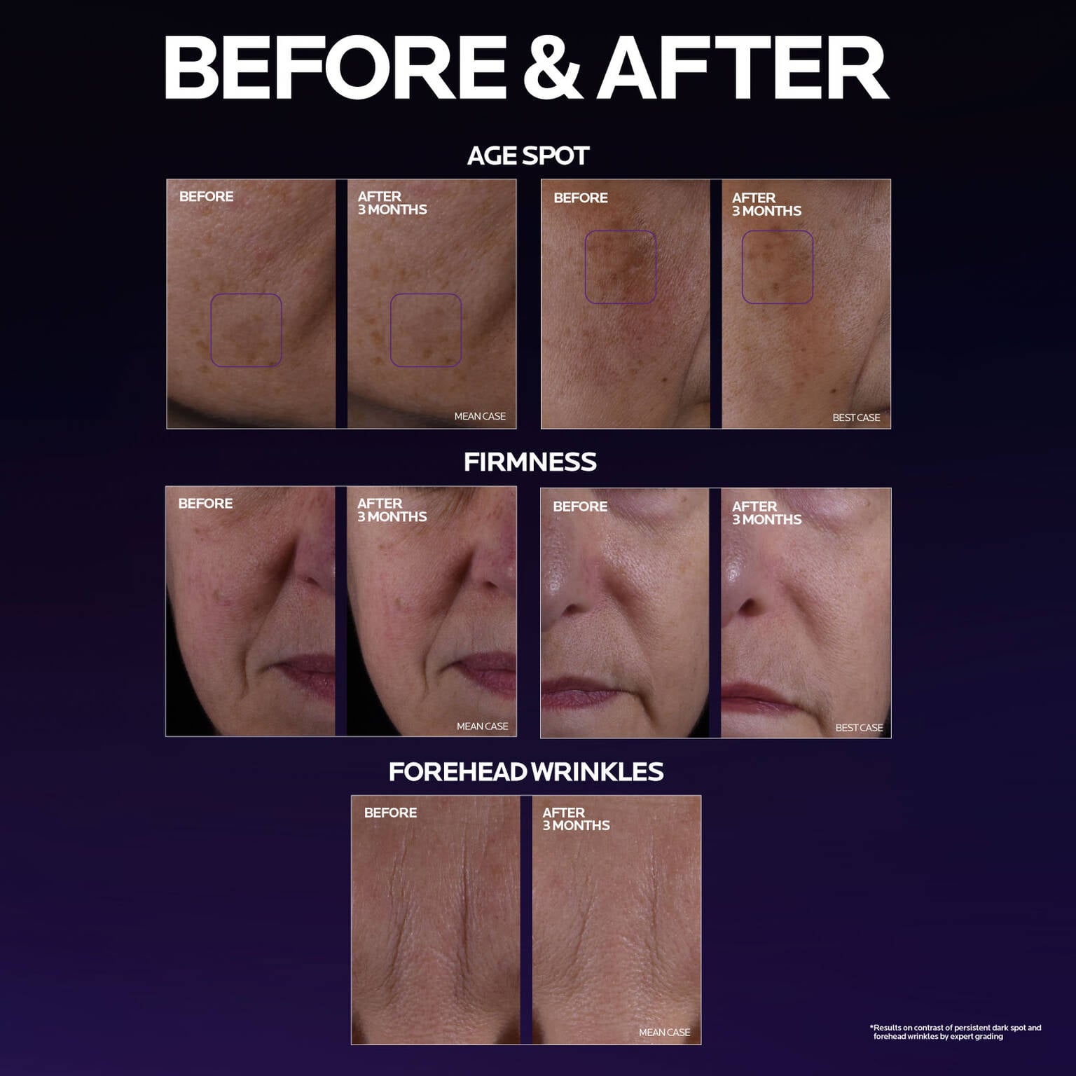 mela-b3-double-dose-discoloration-treatment-with-melasyltm-g1 MelaB3_DD_BTF_BeforeAfter_1500x1500_5.jpg